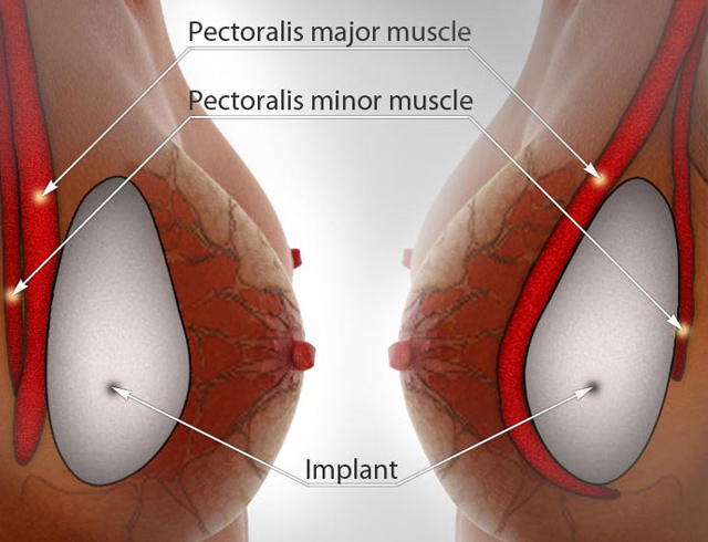 marirea-sanilor-cu-implanturi-siliconice-1